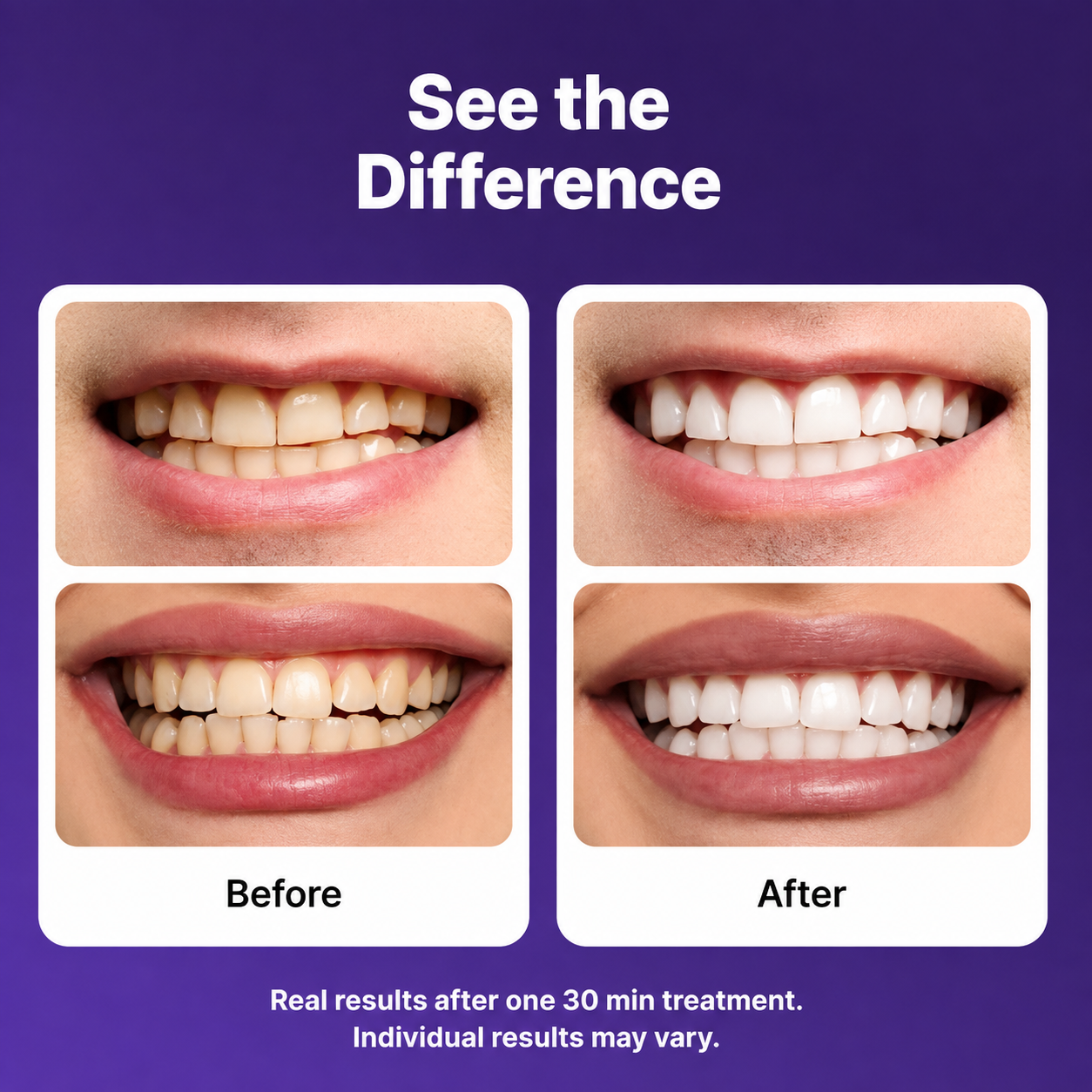 Teeth Whitening Strips
