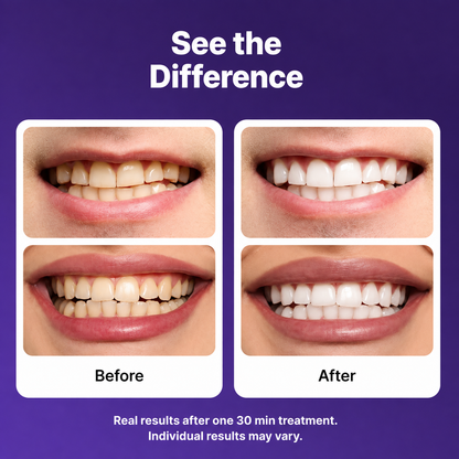 Teeth Whitening Strips